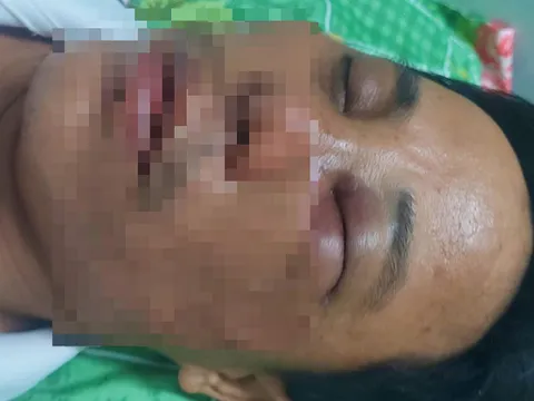 Bình Thuận: Mời học sinh lên làm việc, thầy hiệu phó bị phụ huynh đánh gãy mũi